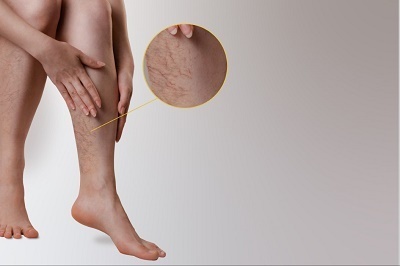 what to expect at a vein clinic.jpg