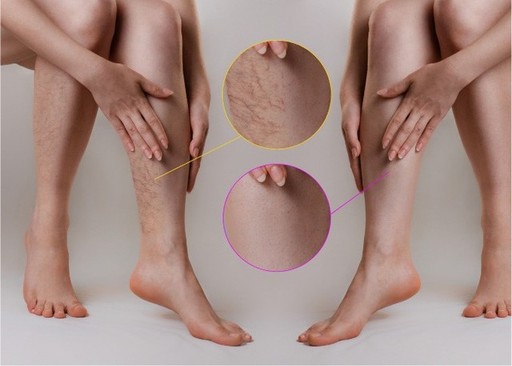 What doctor treats varicose veins.jpg