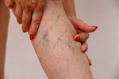 What is a Vein Specialist Called.jpg