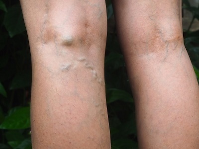 what is a vein doctor called.jpg